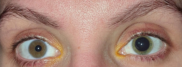 Bigpicture ru physical mutations that prove were all one of a kind life is awesome beautiful interesting shocking mind blowing humanity 032922 2