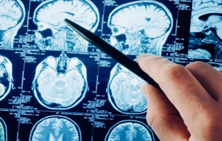 Что такое инсульт простыми словами. Чаще всего люди страдают от ишемического инсульта, геморрагический встречается гораздо реже. Фото.