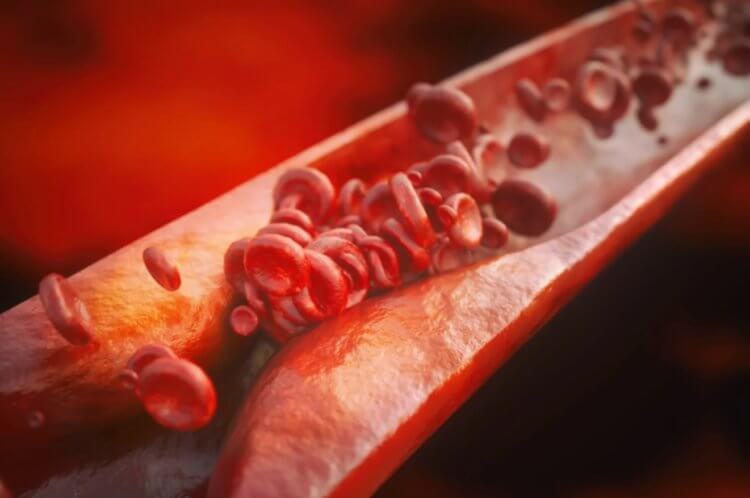 Распространенные причины инсульта. Распространенной причиной инсульта является атеросклероз. Фото.